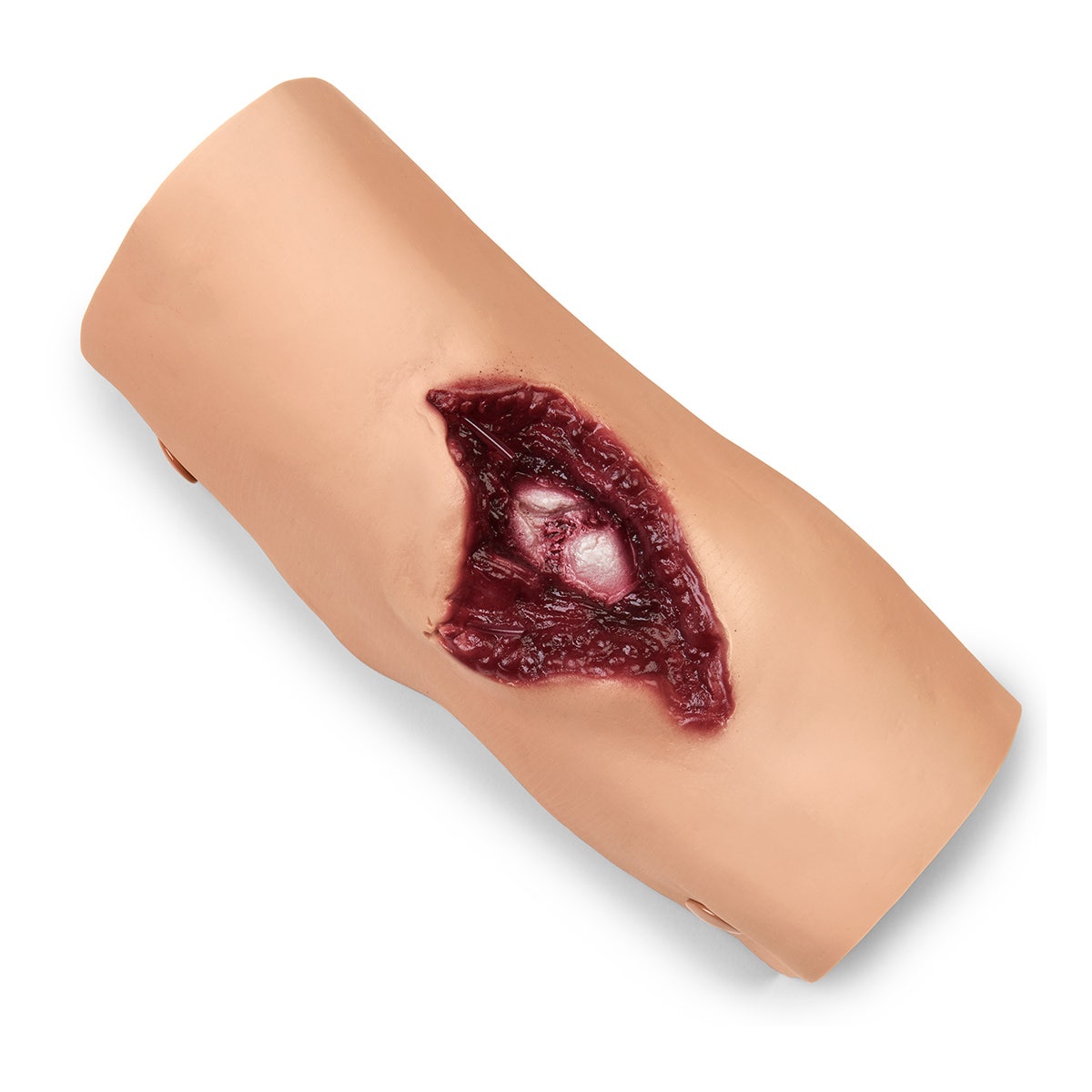 800-6816-Compound Fracture - Humerus