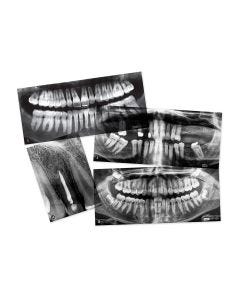 Dental X-Rays - Set of 15