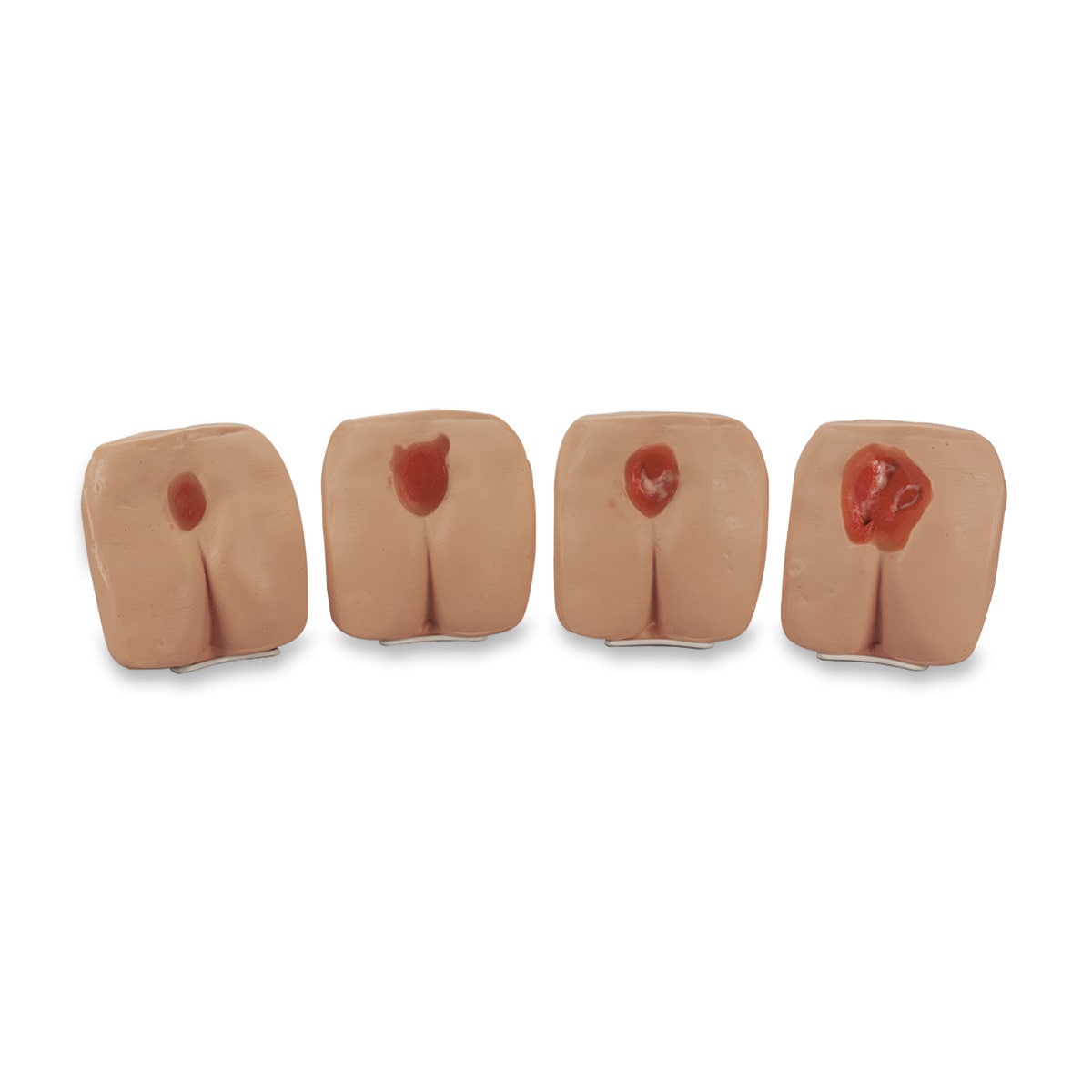 X0000LF00934-Life/form® Pressure Ulcer/Bedsore Model