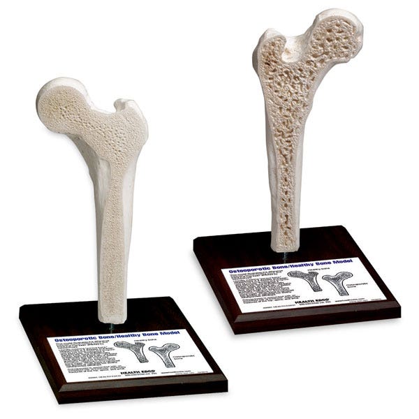 SB36932-Osteoporosis Model - 6 in. x 9 in. x 8 in.