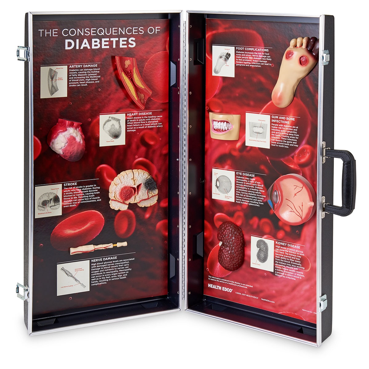 SB36978-The Consequences of Diabetes 3-D Display - 28 in. x 27 in.