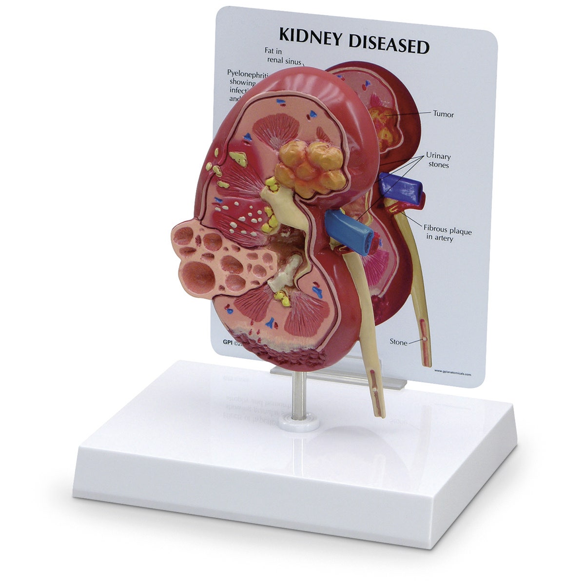 SB46337-Kidney Model with Pathologies