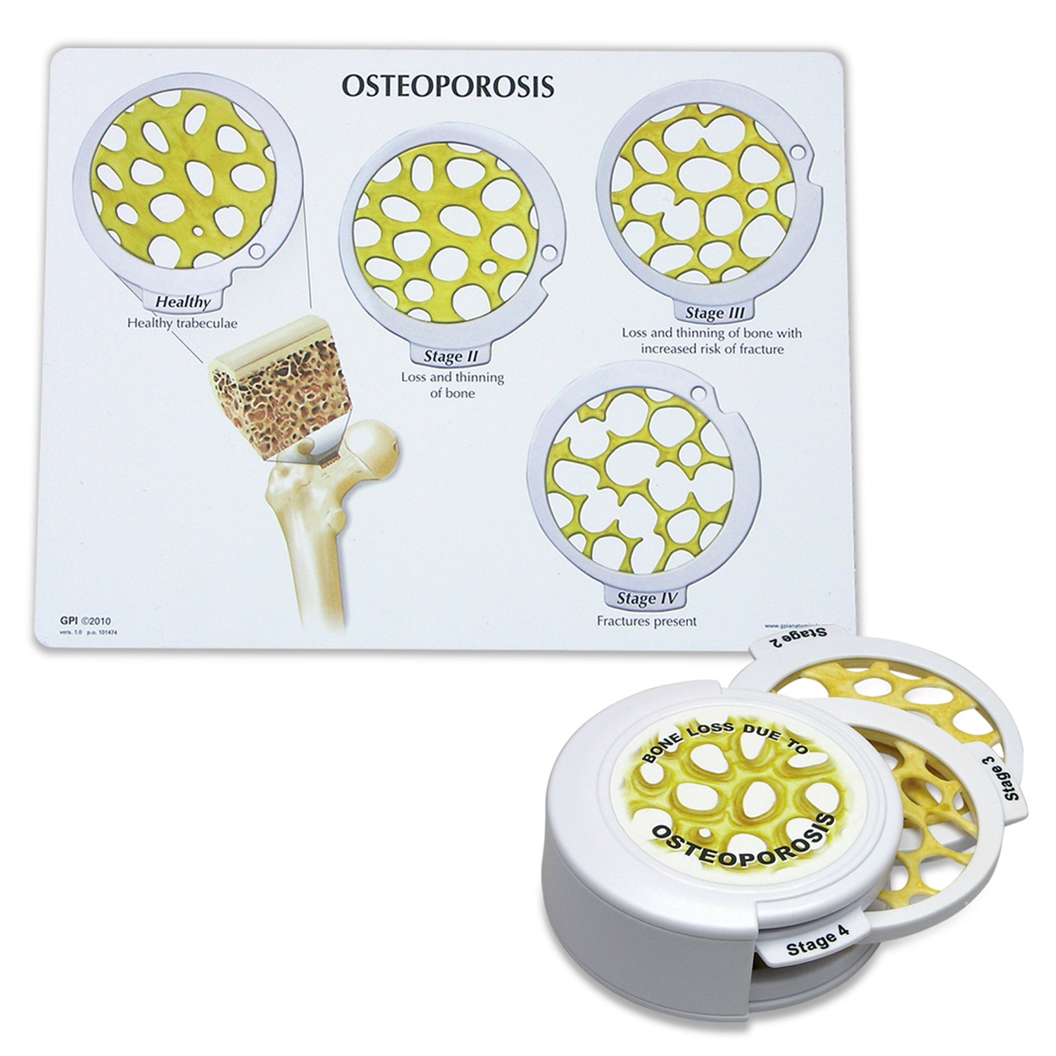 SB48059-Osteoporosis Disk Set