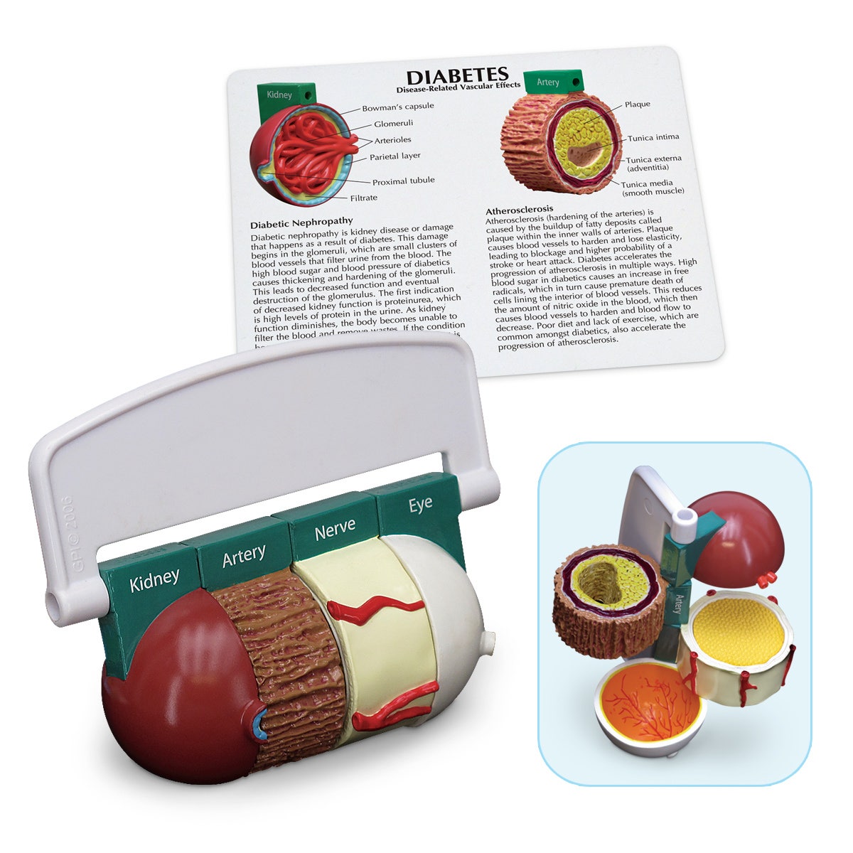 WA29777-Diabetes Model (4-Part)